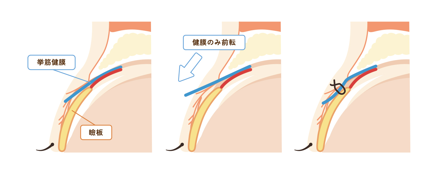 挙筋腱膜前転法