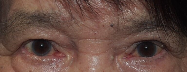 両側眼瞼下垂症（左顔面神経不全麻痺合併）