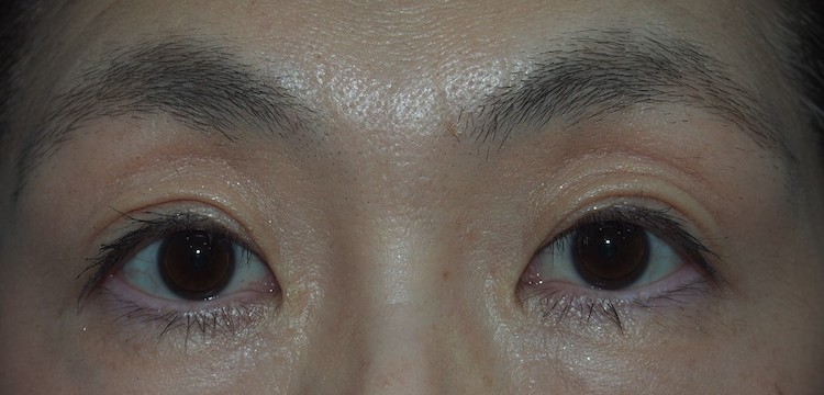 術後3ヶ月